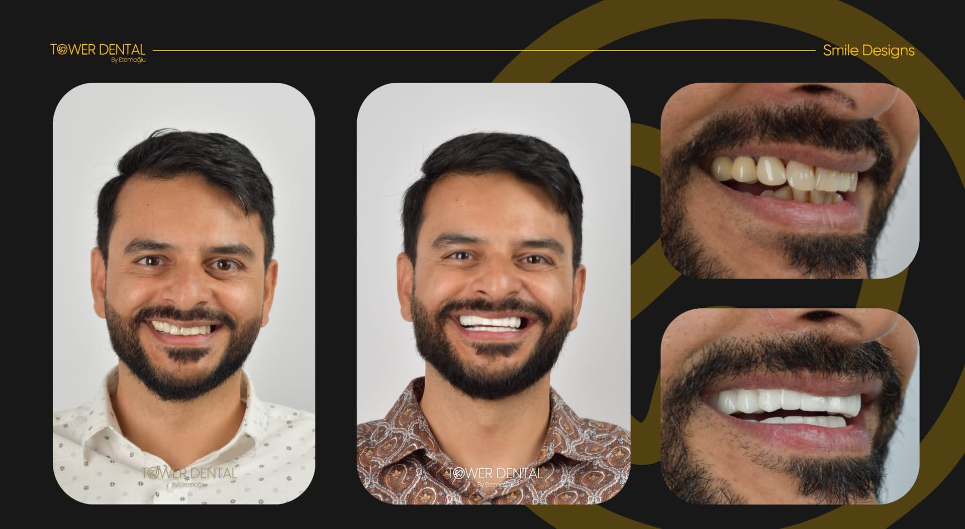 Real result · Tower Dental Clinic, Istanbul